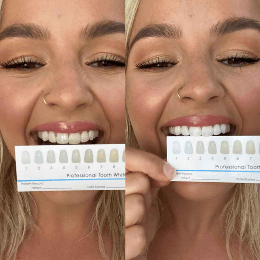 Advanced Teeth Whitening Kit - SmilePro Worldwide