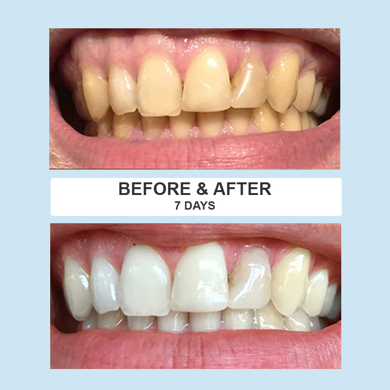 SmilePro before and after results