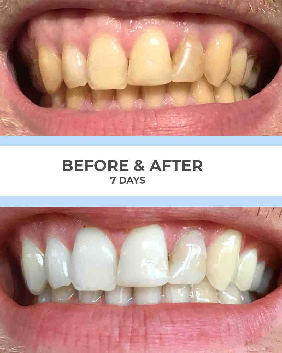 SmilePro before and after results