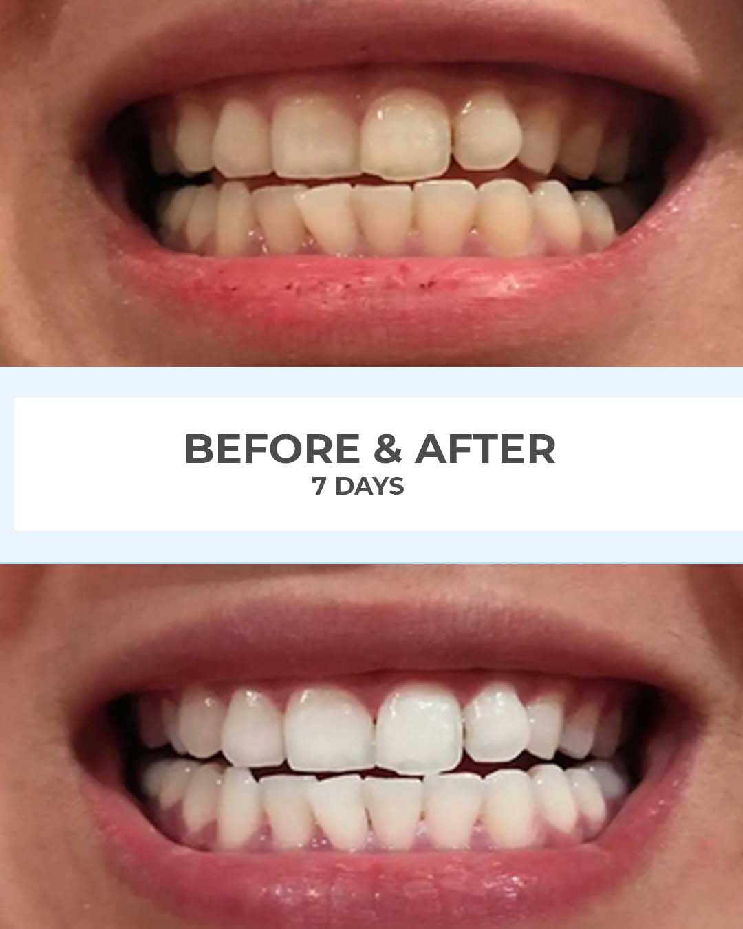 SmilePro before and after results